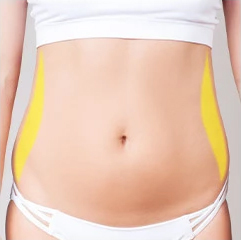 Diagram of how cryolipolysis works to slim the body.