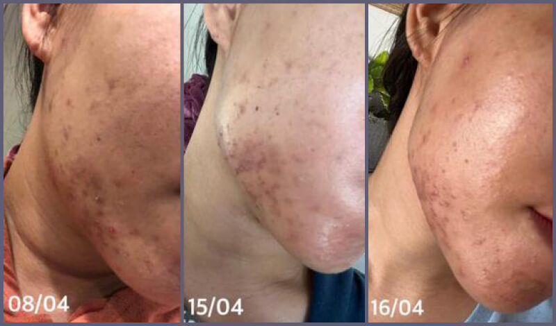 Acne-BeforeAfter-1