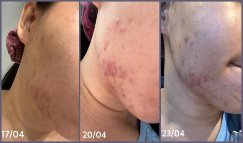 Acne-BeforeAfter-2