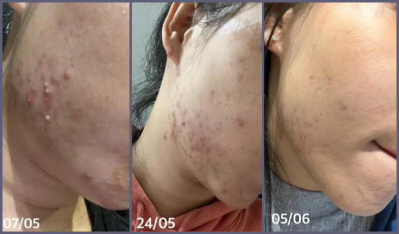 Acne-BeforeAfter-3