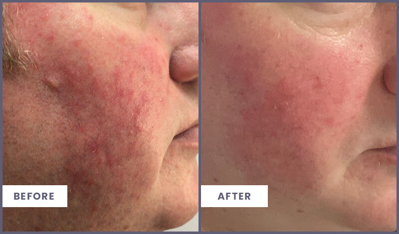 Acne-BeforeAfter-4